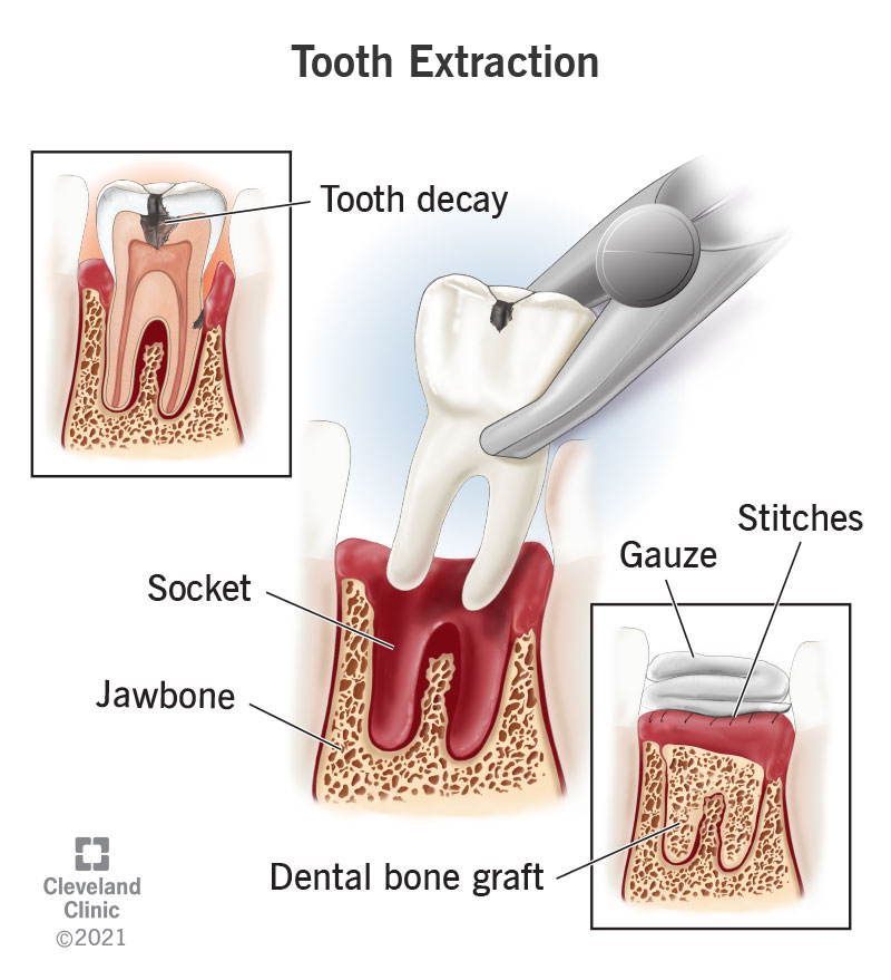 tooth-extraction.jpg